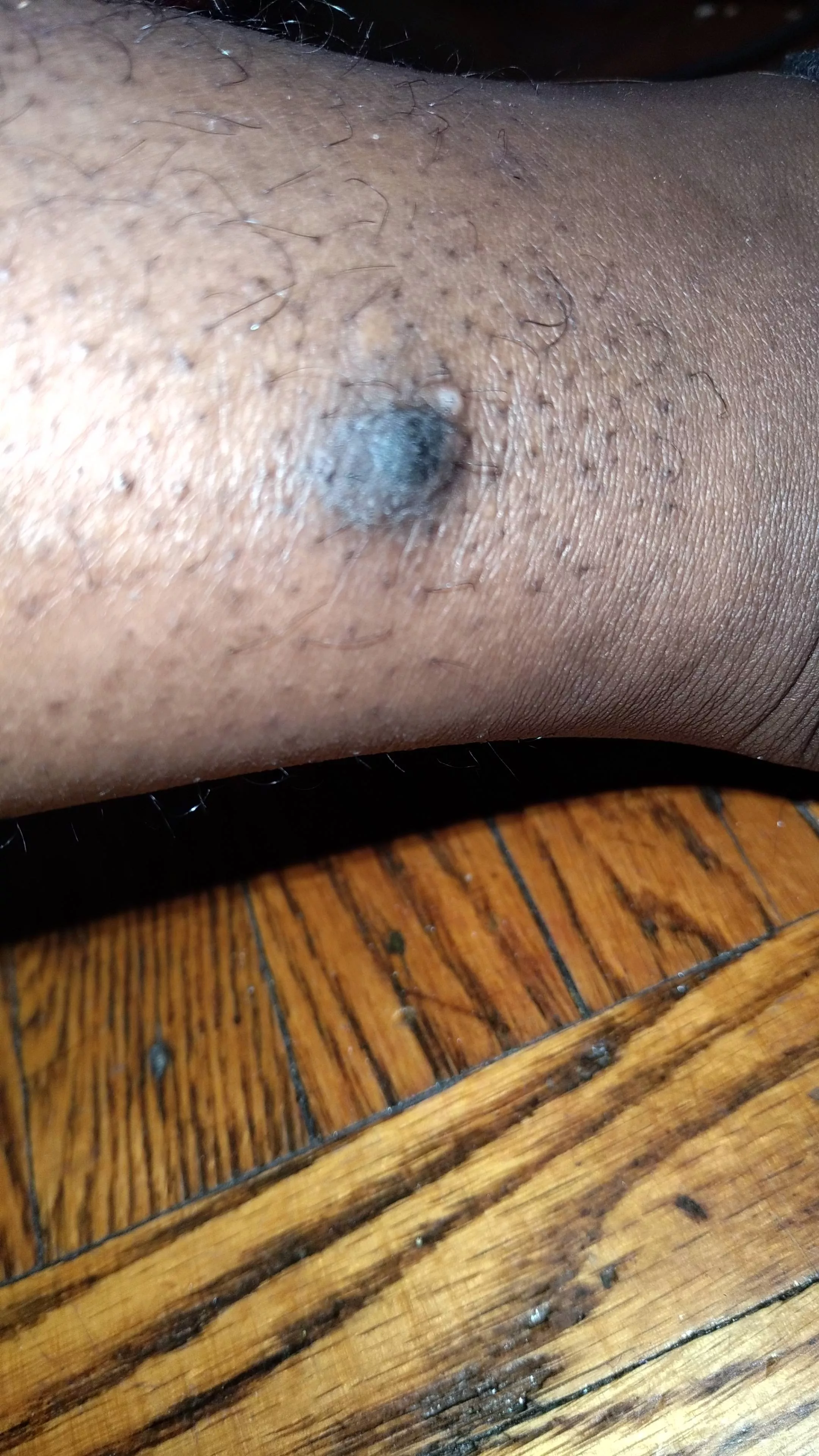 Update Pt 3 still being told it's a blister got an x ray on my leg because it hurts posted by caseyscolumbusss