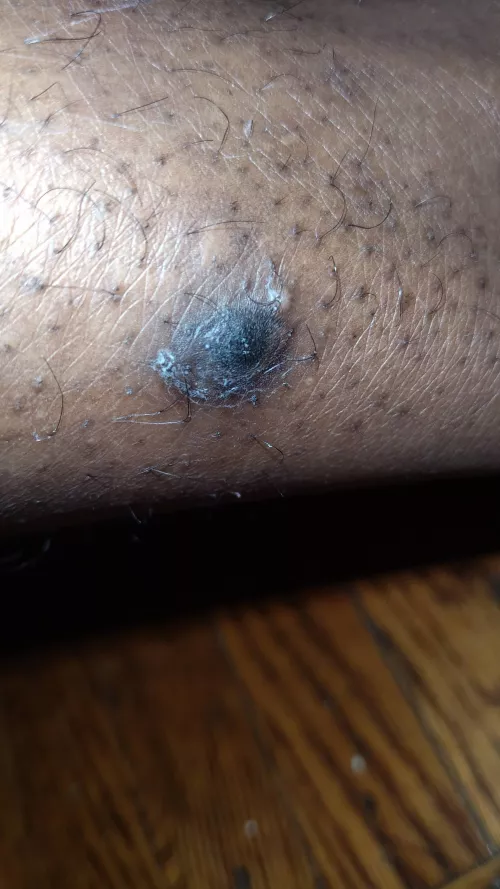 Update Pt.4 Doctor said it looked infected gave me pills and cream. by caseyscolumbusss