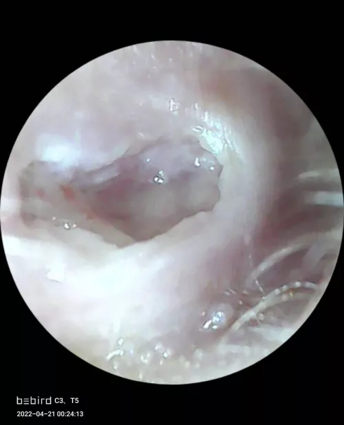 Well here it is, the VERY painful and bruised hole left behind after the top of my cholesteatoma broke off. ENT are sending me an appointment letter to get a fresh look by Living-Ad-6751