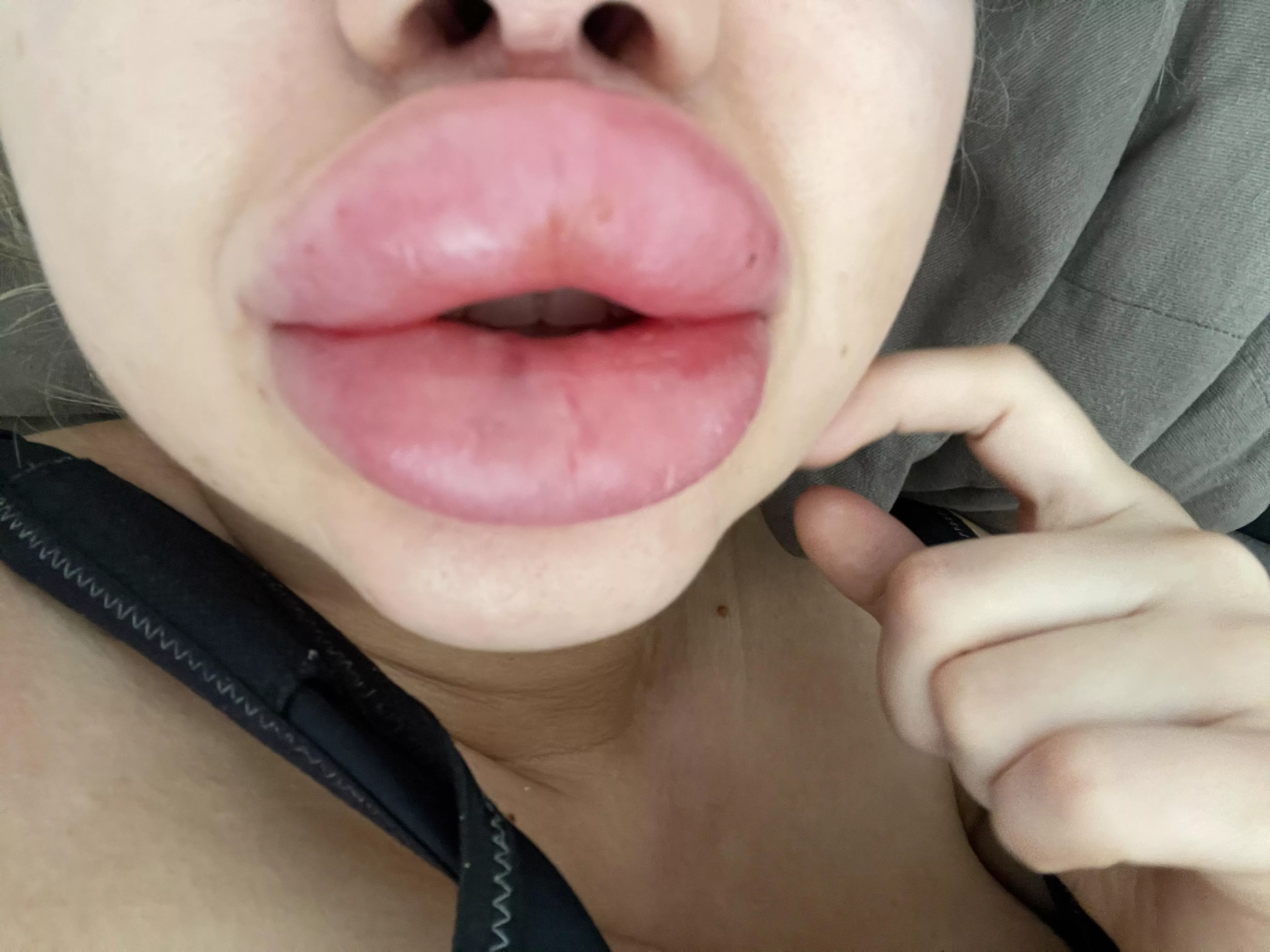What do you think about my Bimbolips (two days after injection) posted by Jessy_Bunny