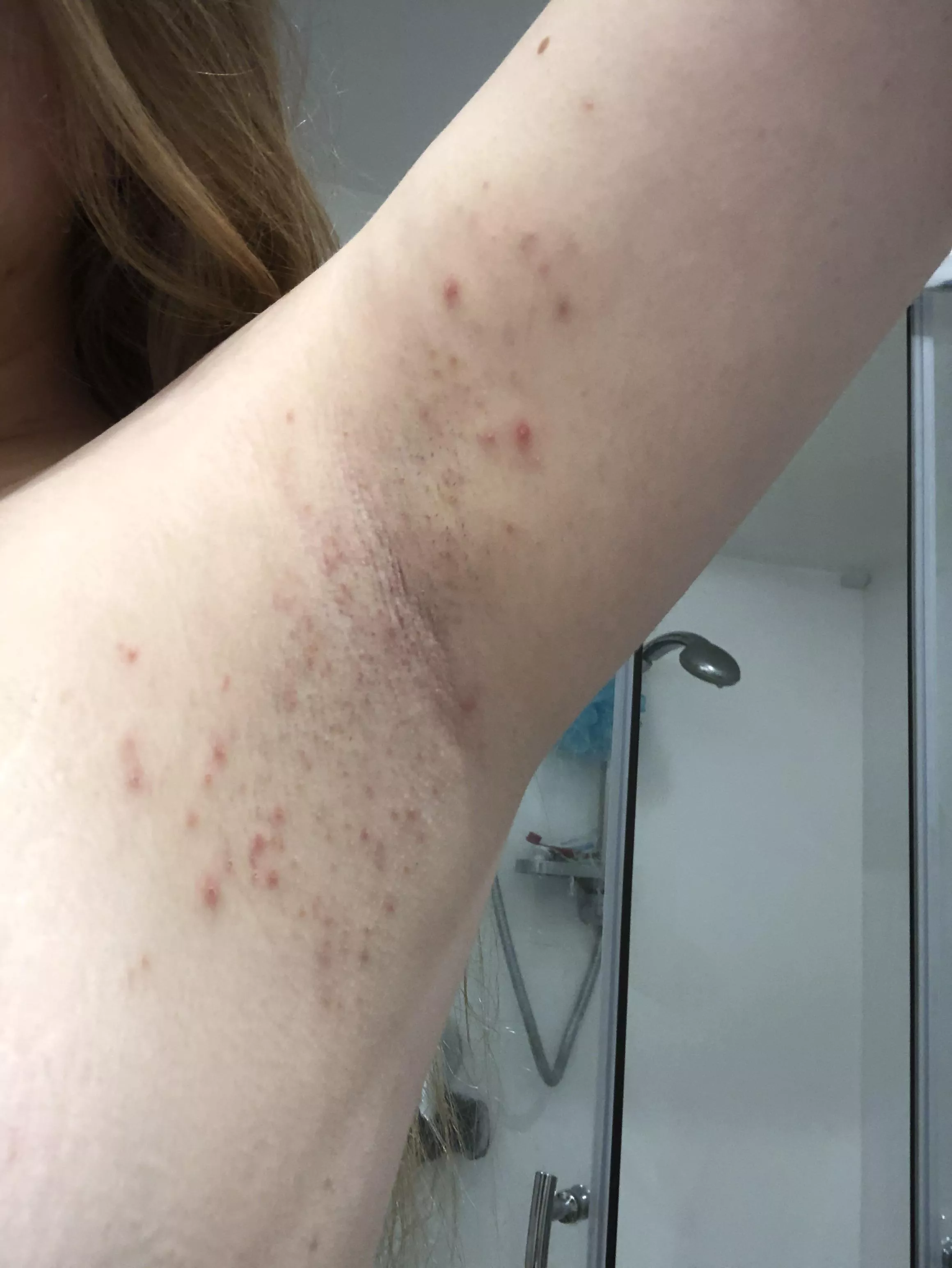 What is this? I keep getting reoccurring pimples above & below my armpits. The pimples themselves are sore, usually whiteheads but sometimes there’s deep larger ones too, it tends to last 2-3 weeks at a time & I don’t get pimples anywhere els posted by randomusername19191