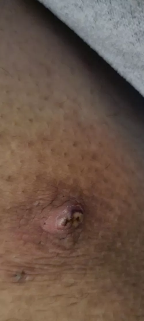 what is this? it's on my inner thigh where my legs rub. hard to walk cause it hurts when it rubs by RoutineMixture4149