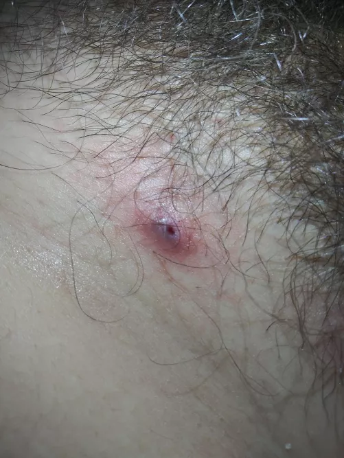 what is this on my pubic area bloody pus came out of it. it was pretty hard the past couple days but today i barely touched it and it just popped by FinalMixture6080