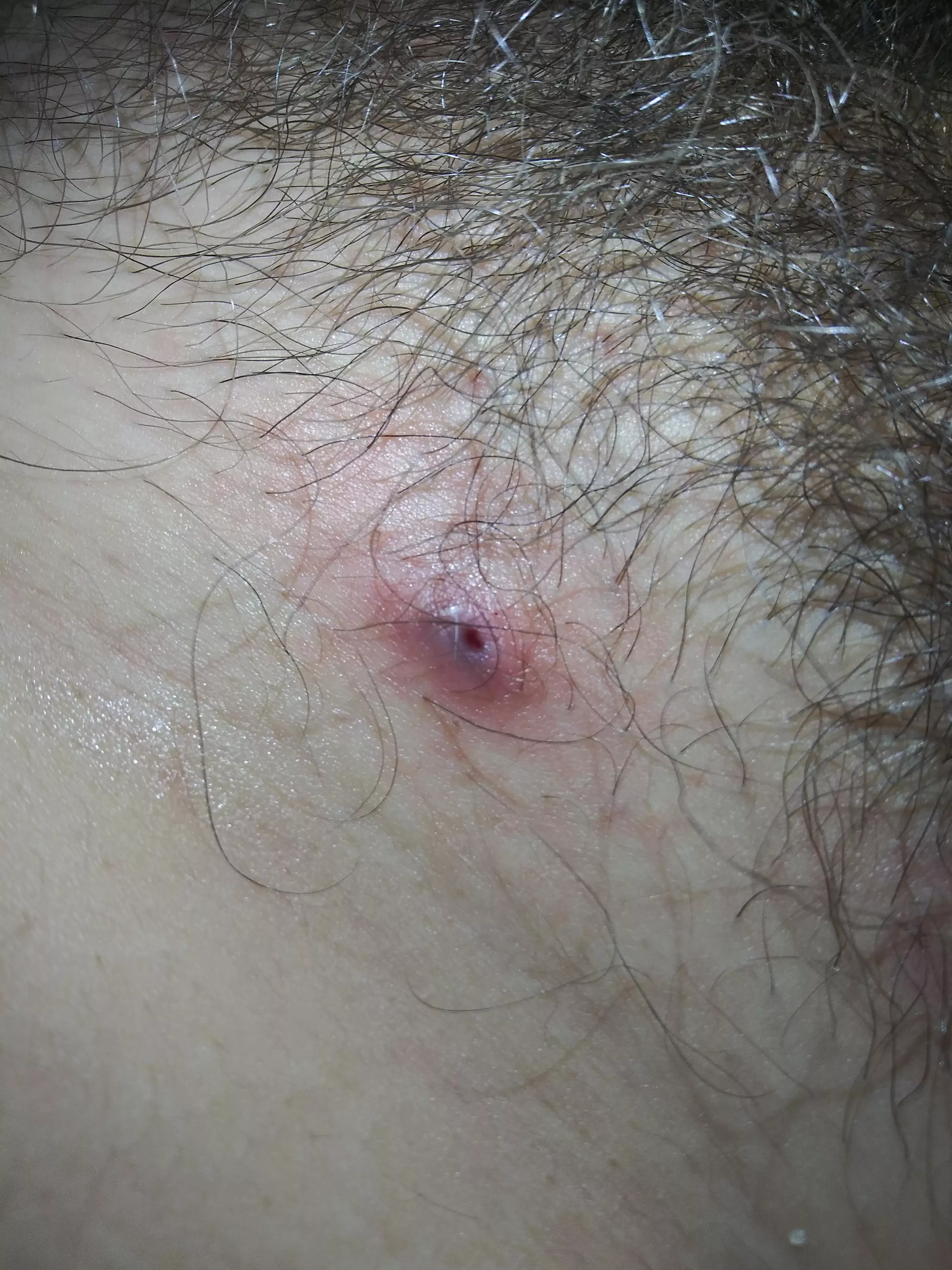 what is this on my pubic area bloody pus came out of it. it was pretty hard the past couple days but today i barely touched it and it just popped posted by FinalMixture6080