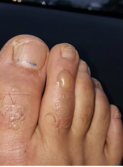 What liquid nitrogen burns look like ! by FaulkemintheAho