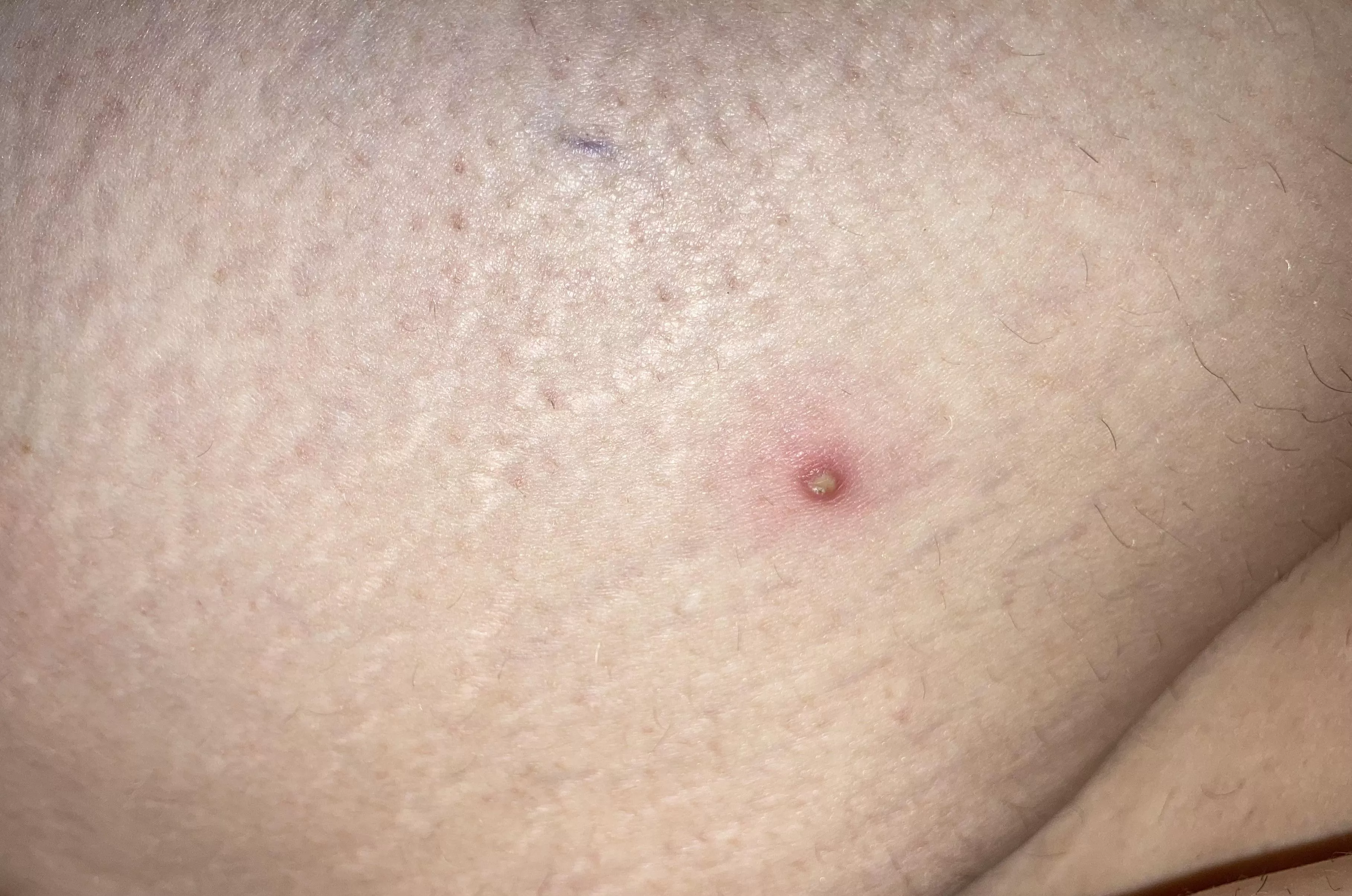 Whitehead that popped up over night on the back of my upper thigh. posted by Sad_Picture6708