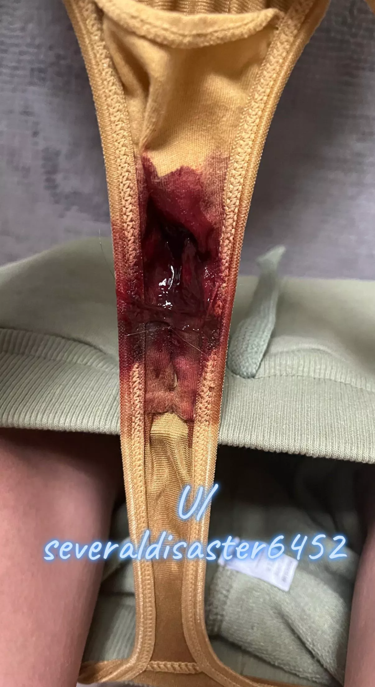 Woke up bloody posted by Several-Disaster6452