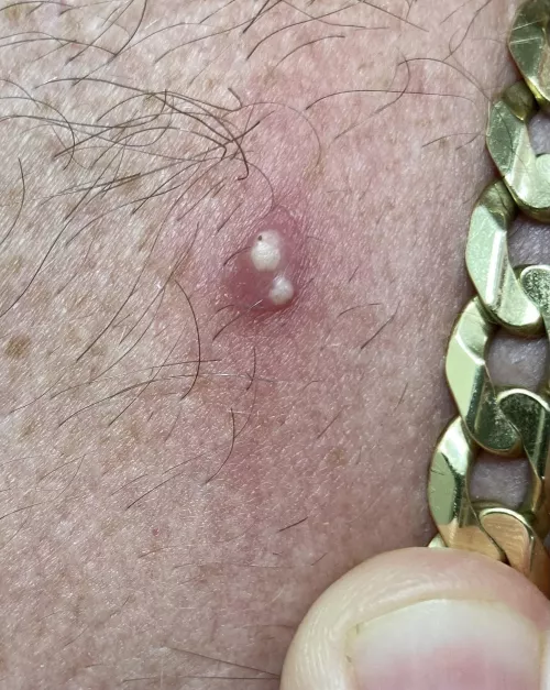 Woke up with 2 holes surrounded by redness on my neck. I thought was a spider bite, but now I’m not sure. by Leg_Mcmuffin