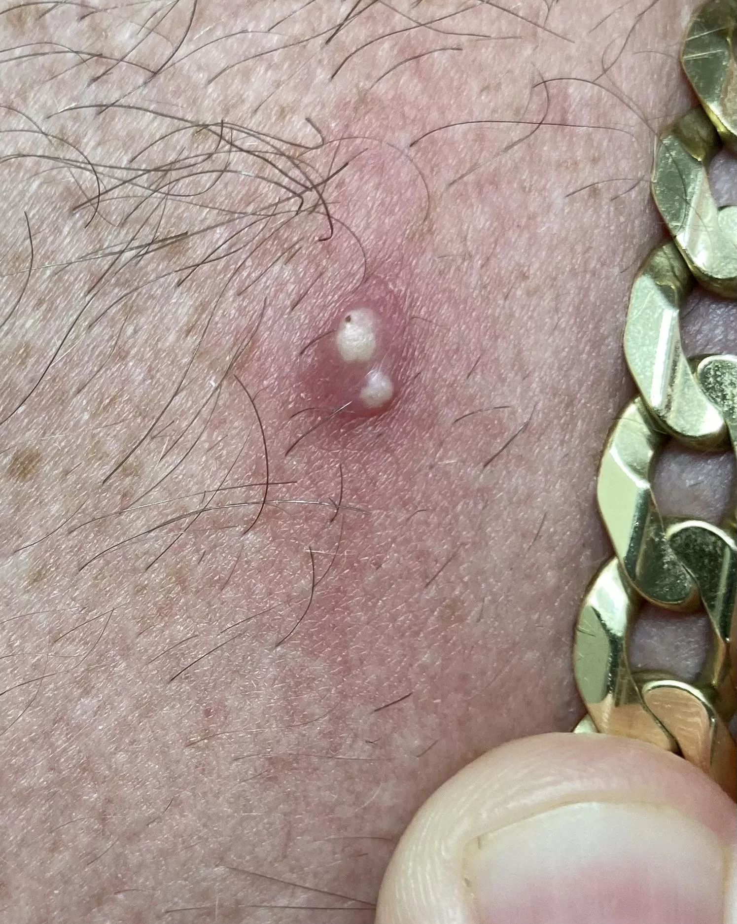 Woke up with 2 holes surrounded by redness on my neck. I thought was a spider bite, but now I’m not sure. posted by Leg_Mcmuffin