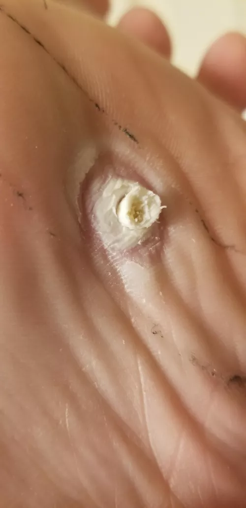 Words cant Express how badly I want this fucker out of my foot. by TatoBean