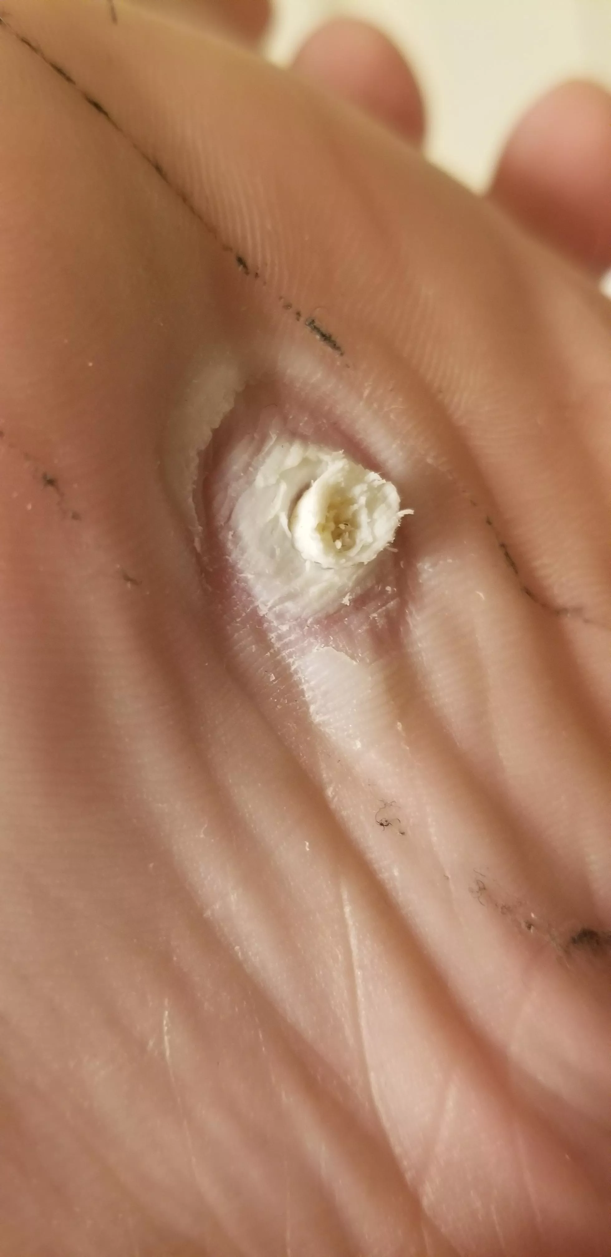 Words cant Express how badly I want this fucker out of my foot. posted by TatoBean