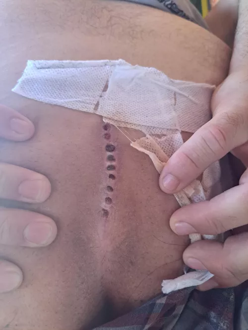 Got surgery for my cyst done. Hurts like all hell. by scrublord48