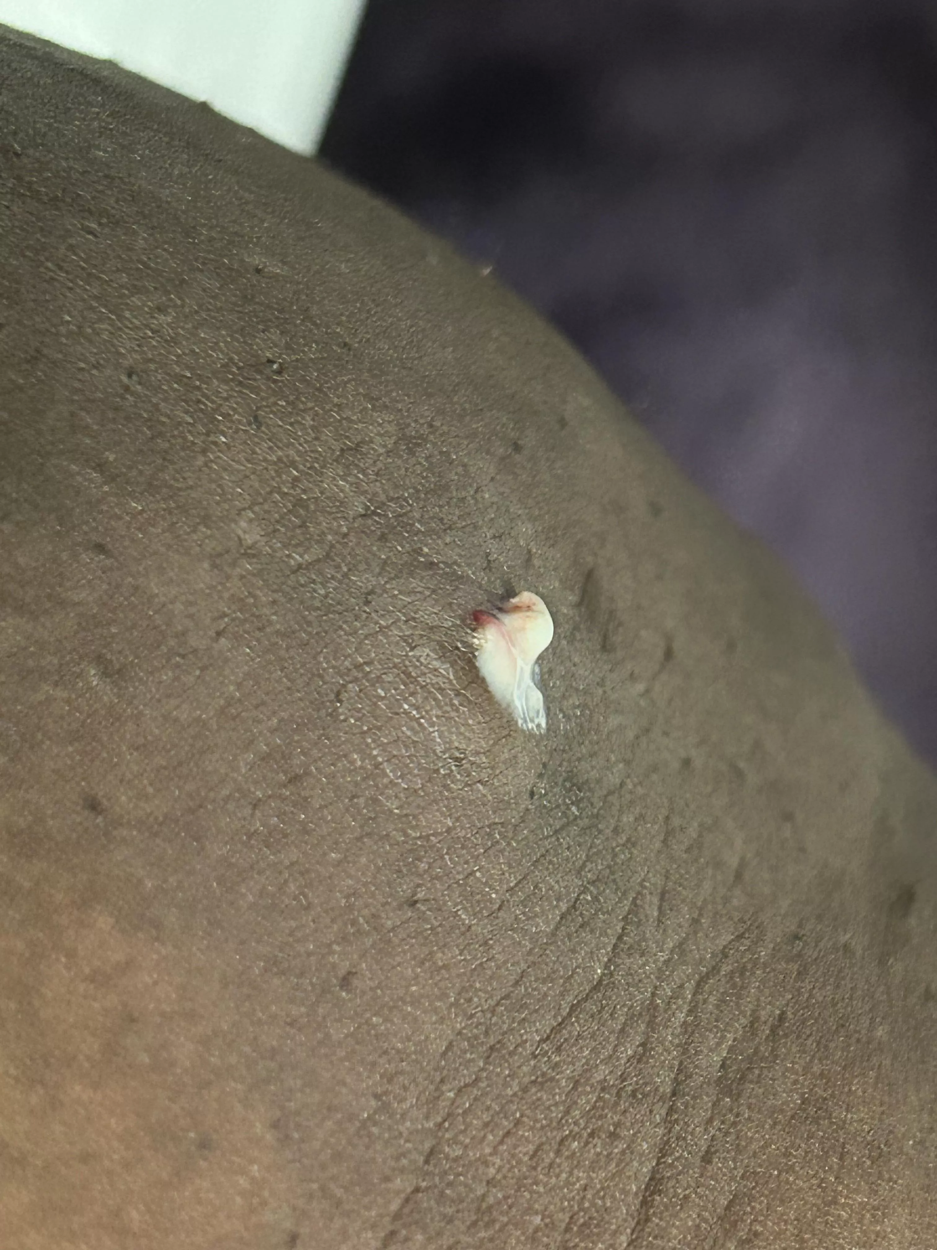 The painful boil on my thigh popped while I was in the bathroom. posted by TheGoddessMoon48