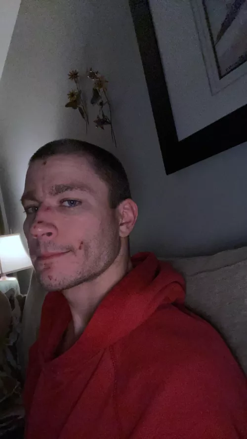 I have a rare skin condition and navigating dating is a tricky thing. I send pics where I don’t have any spots to protect myself from rejection and not accepting it’s part of my identity. Hasn’t worked; If I sent you a face pic would you want me to by druachu