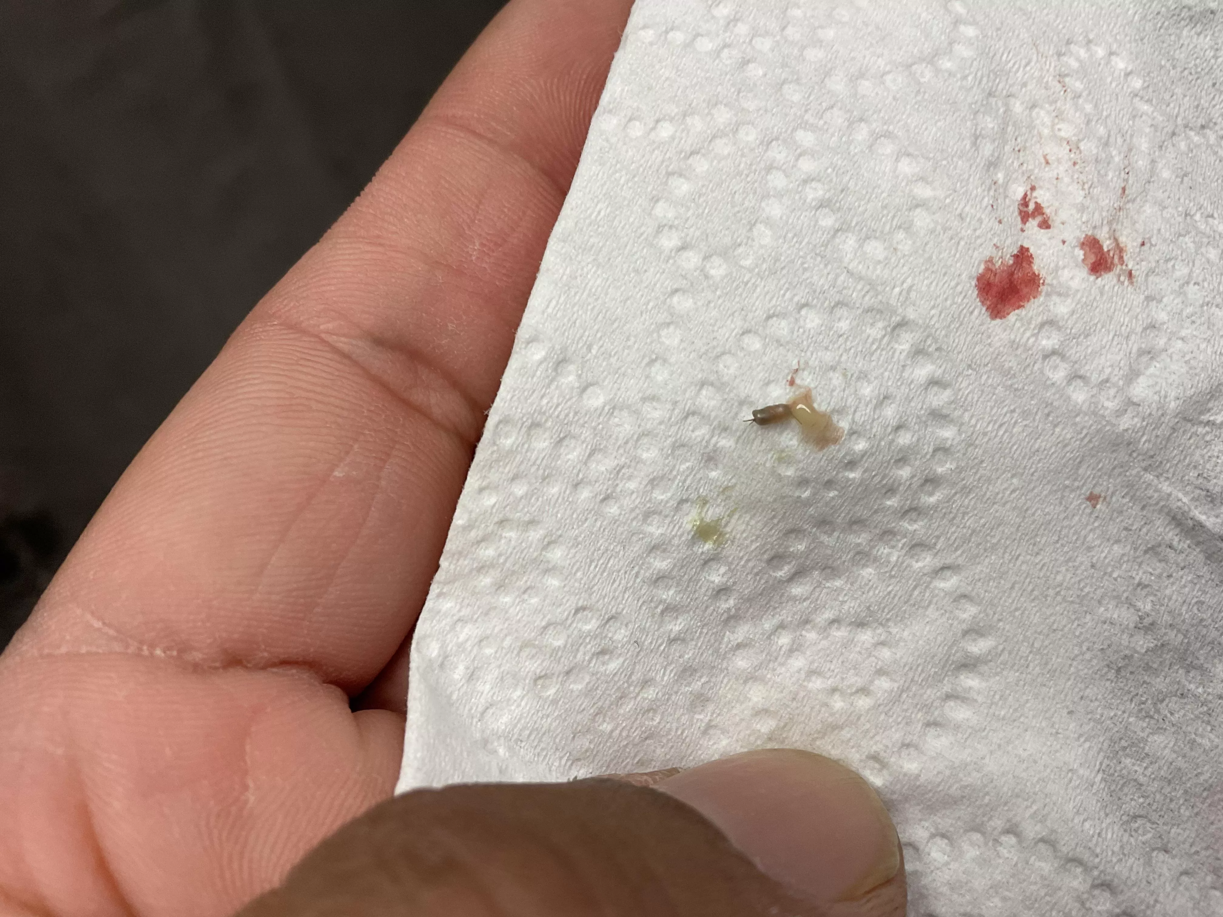 Blackhead/Pimple from the back of my neck. posted by glo-unit