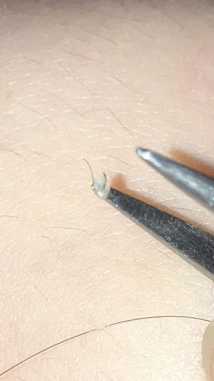 First post! Nice lil thing on my bikini line, didn’t record because self conscious (plus, I’m 17) posted by OrangedJuice1989