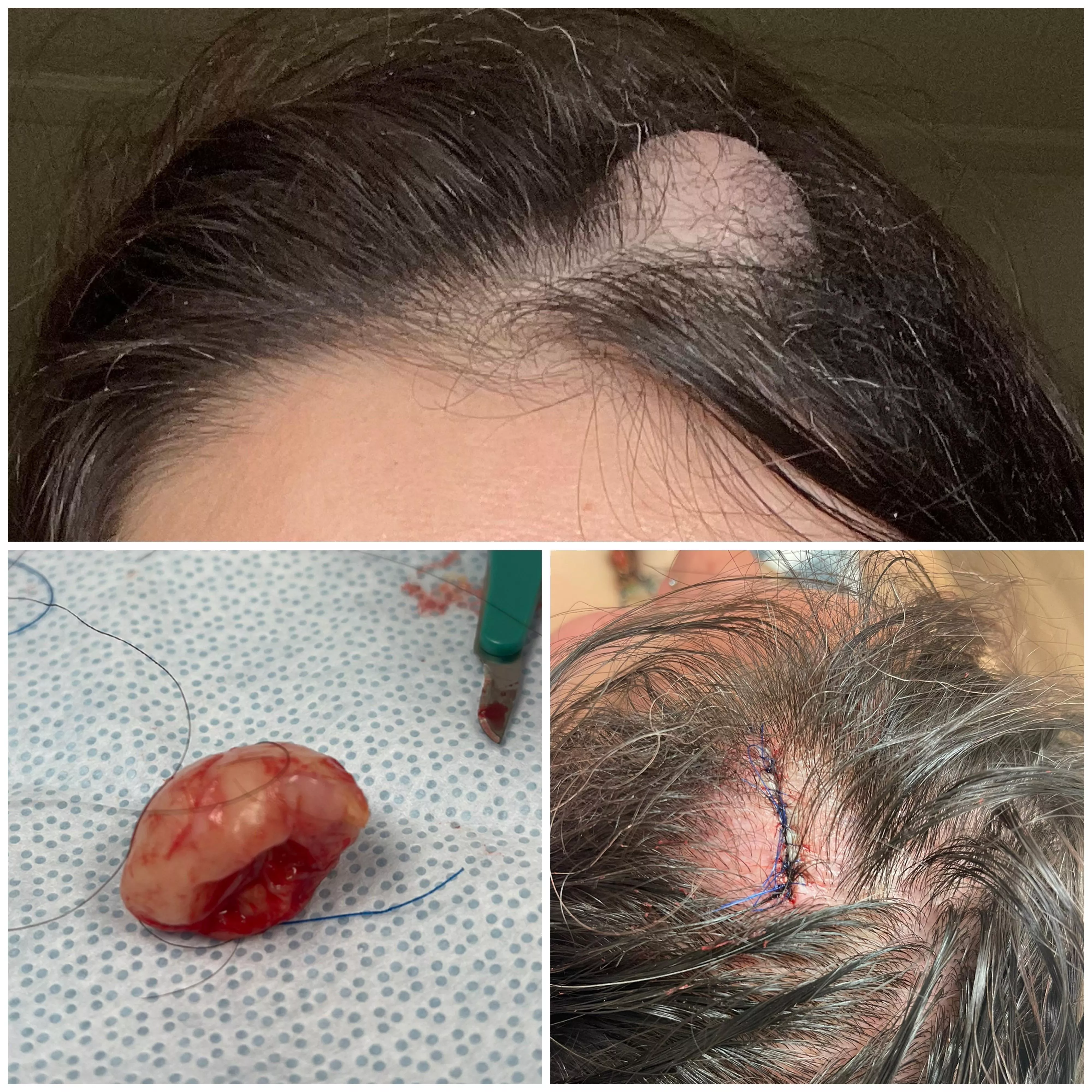 3.9 mm Pilar Cyst Removed & Office Drama, Yesterday posted by MayThOdsEvrBeInUrFvr