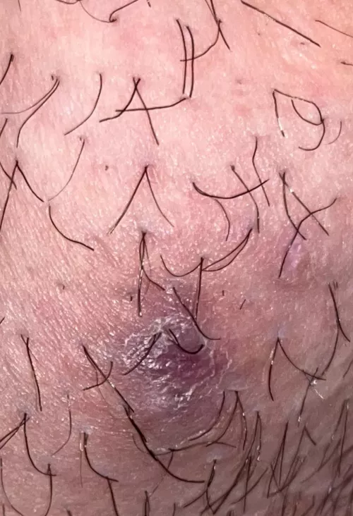 Boil on bikini / vagina area by WalkerBait87