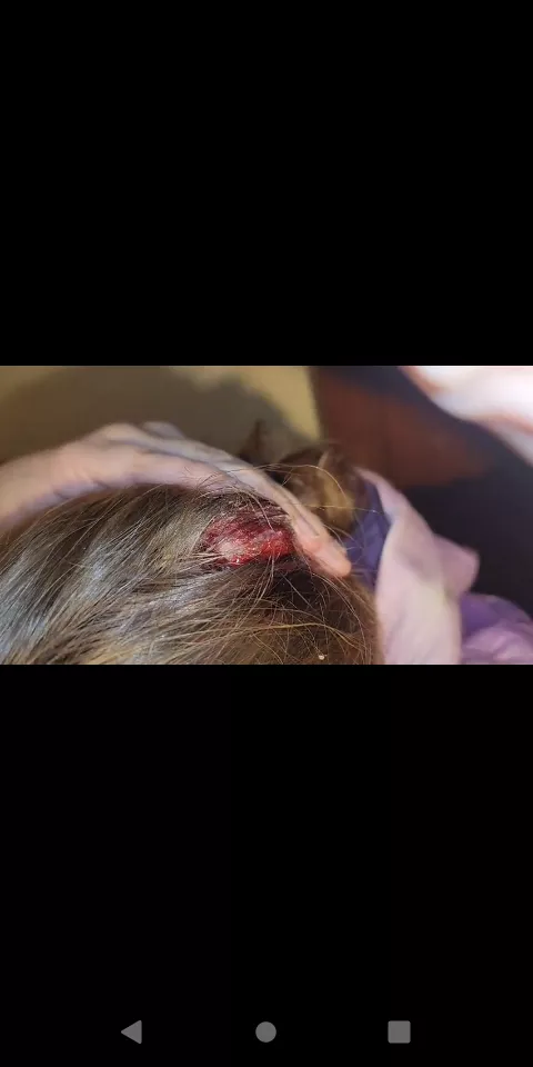 Dont play with abscesses y'all!!! (Update) posted by Haunting_Drawer_5140