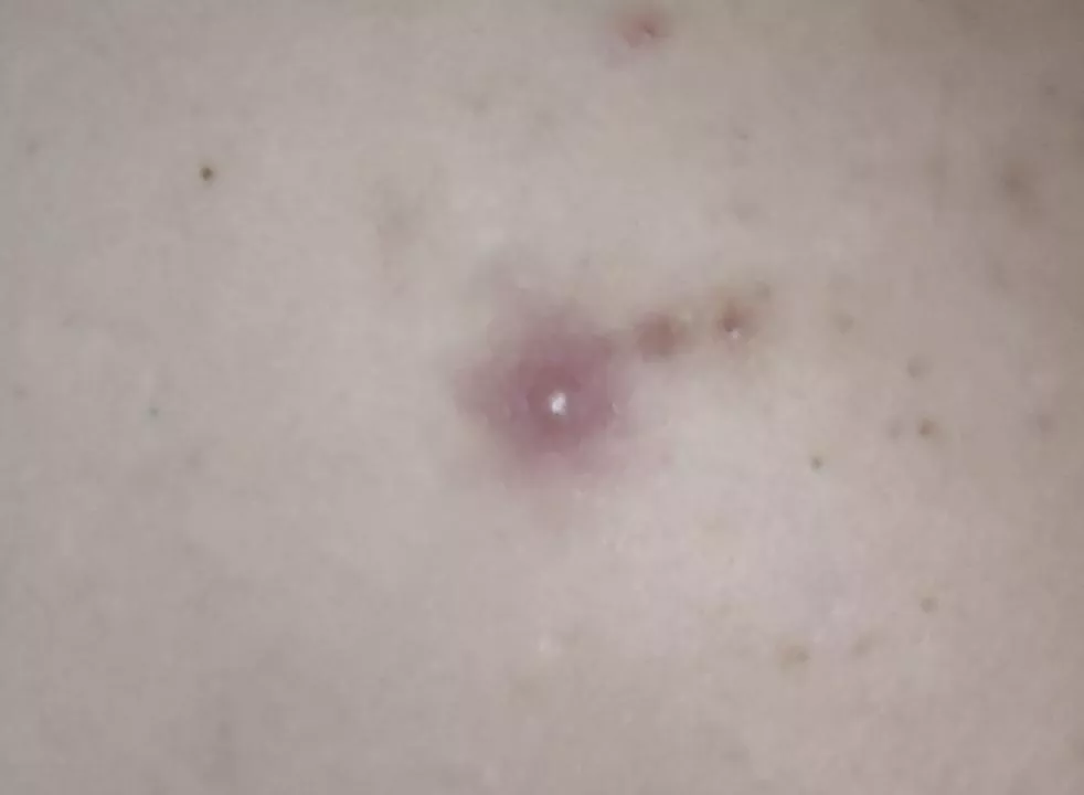 Fiance gets these huge pimples on his back. He lets me try to pop them but they're usually too painful. Waiting for this one to be ready 😅 posted by InvisiblenMiserable