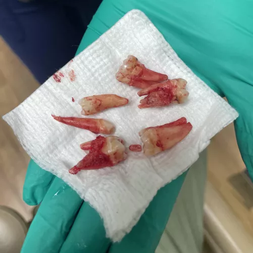 Inspired by the other recent wisdom tooth removal post: 4 wisdom and 2 “shark” teeth pulled in one session. by Nickbc87