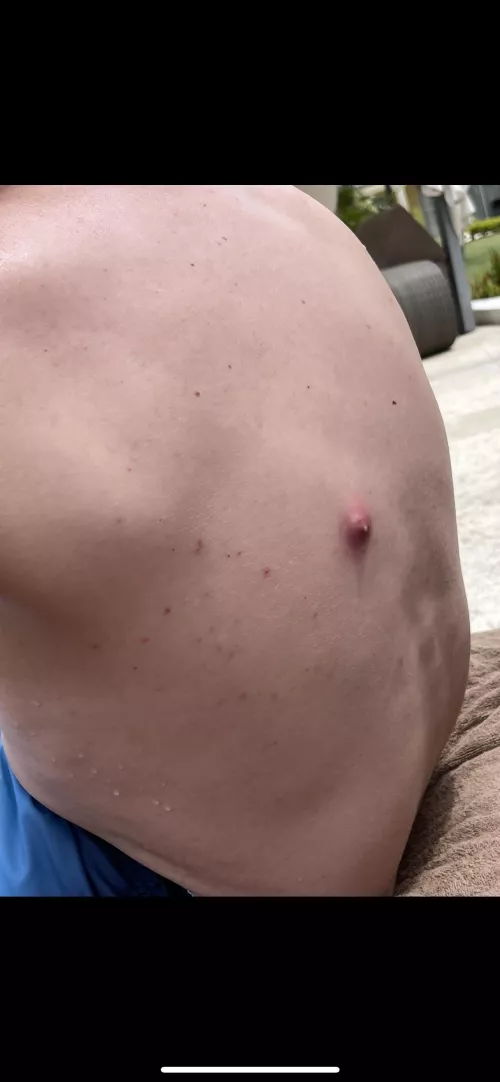 Three years ago partner never told me he had a blackhead. He spent 14 hours on a plane and when we got off it looked like this. It popped a day later (the amount that came out my lord) and never came back. What was it? Tia by pelicannpie