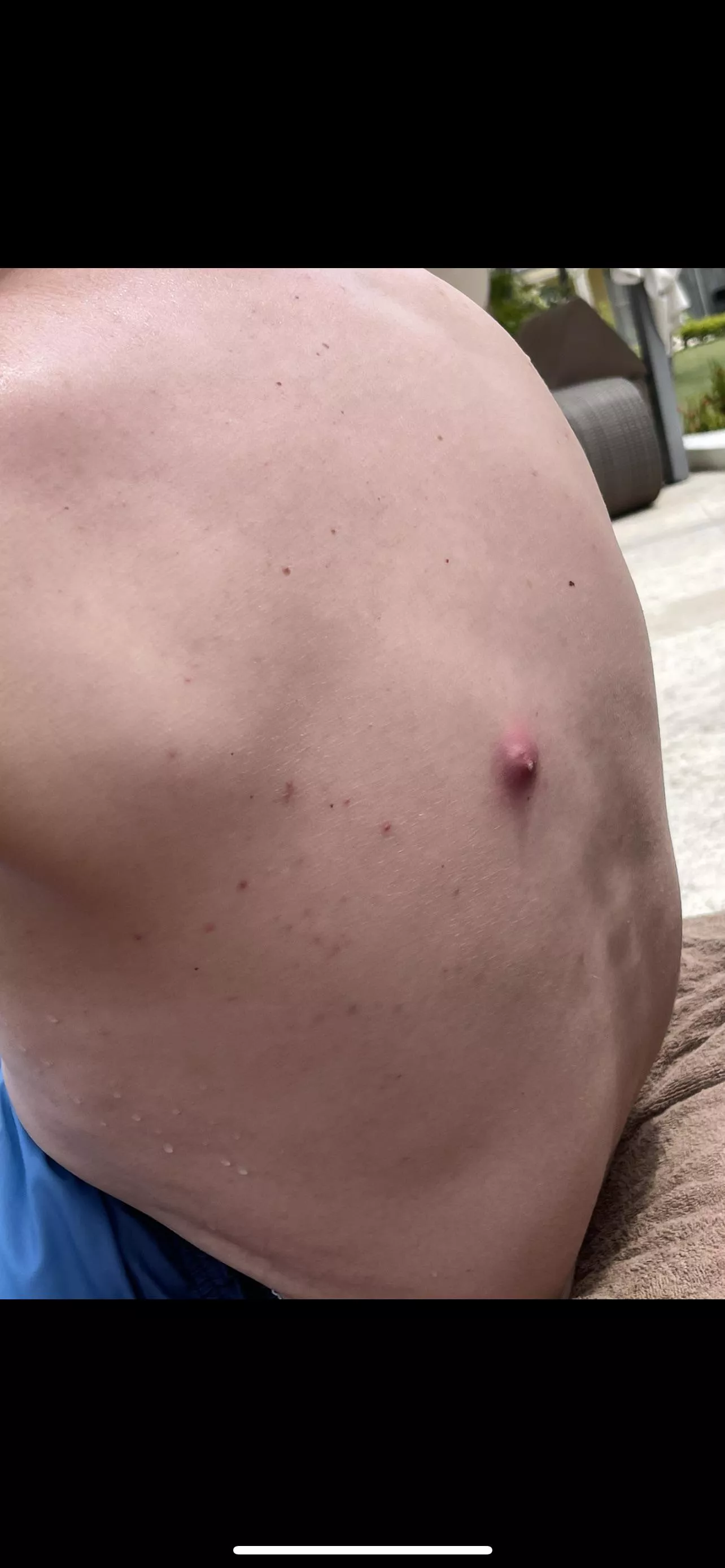 Three years ago partner never told me he had a blackhead. He spent 14 hours on a plane and when we got off it looked like this. It popped a day later (the amount that came out my lord) and never came back. What was it? Tia posted by pelicannpie