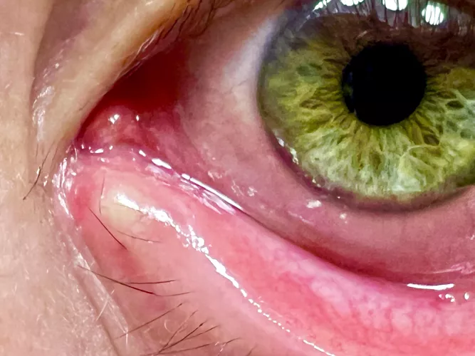 Day 3 of This Stye *Right* on my Tear Duct by mrjoedelaney