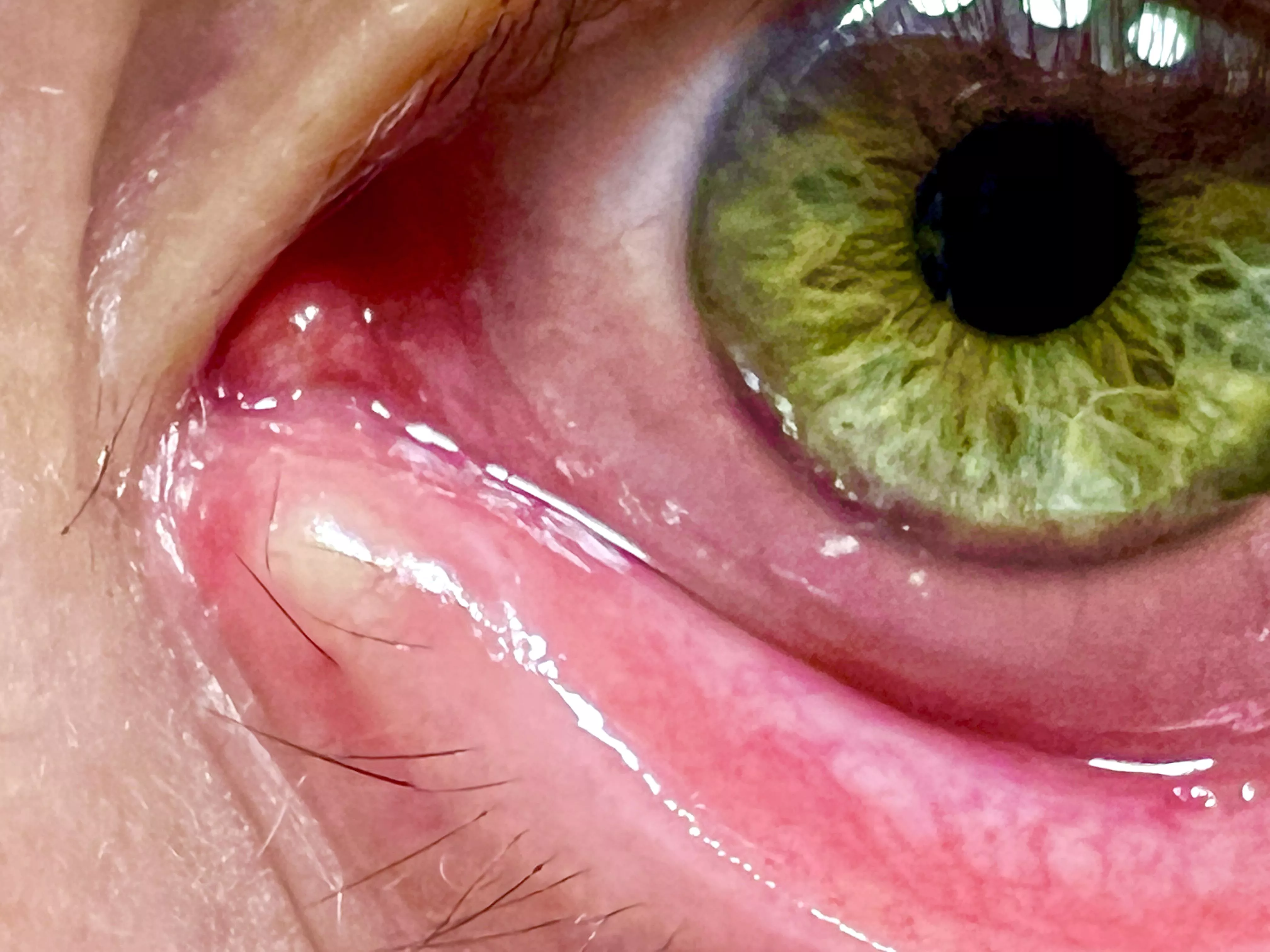 Day 3 of This Stye *Right* on my Tear Duct posted by mrjoedelaney