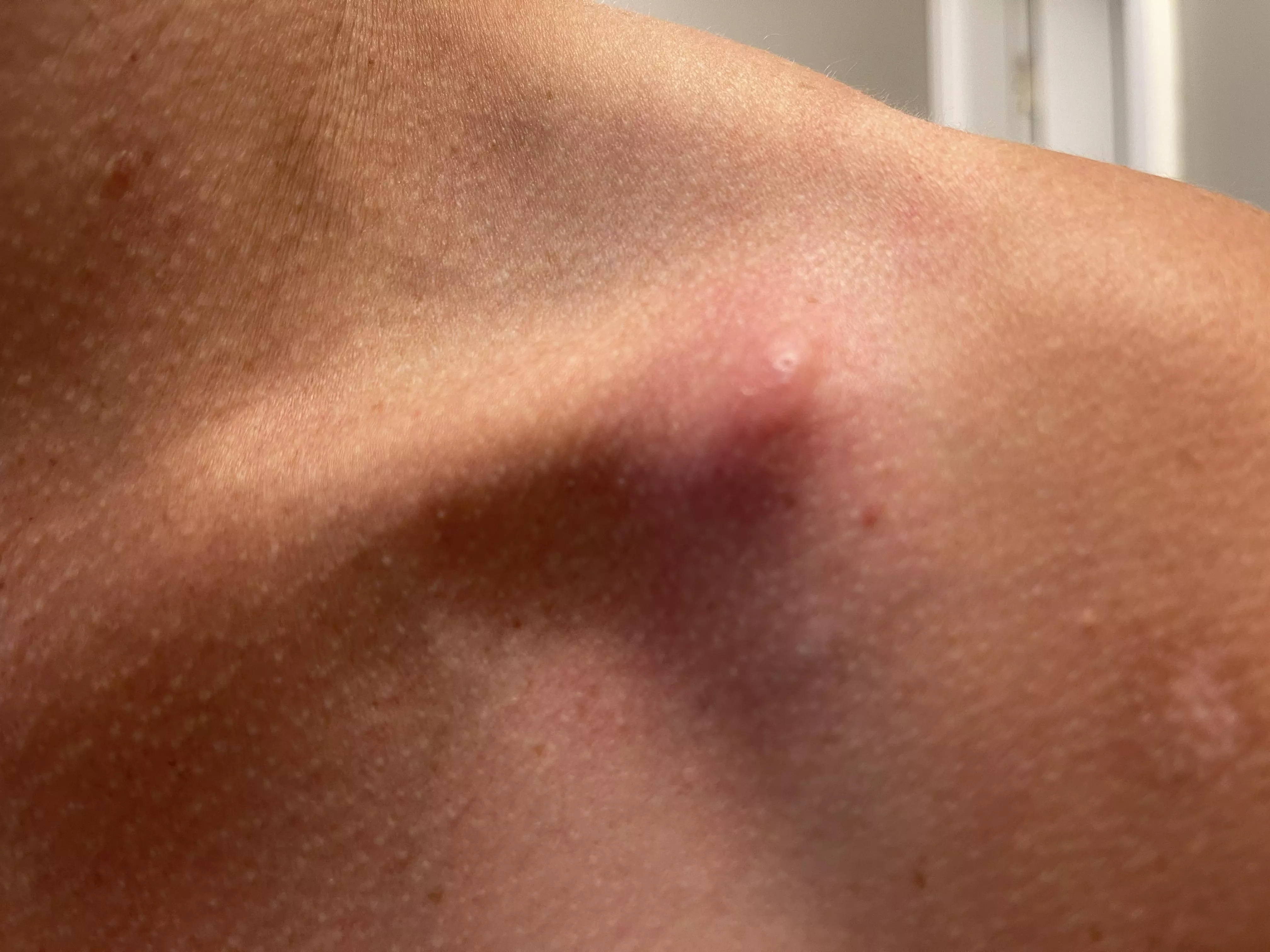 I’ll let this painful collarbone beast brew and report back posted by MirayaJ