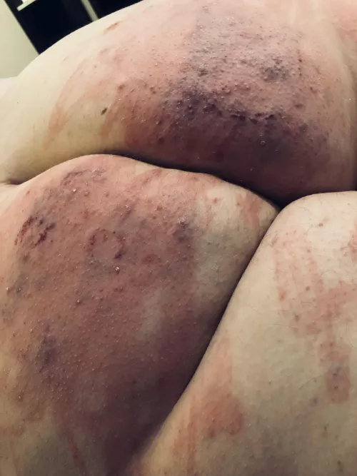 My favorite set of bruises by Theholeyghost69