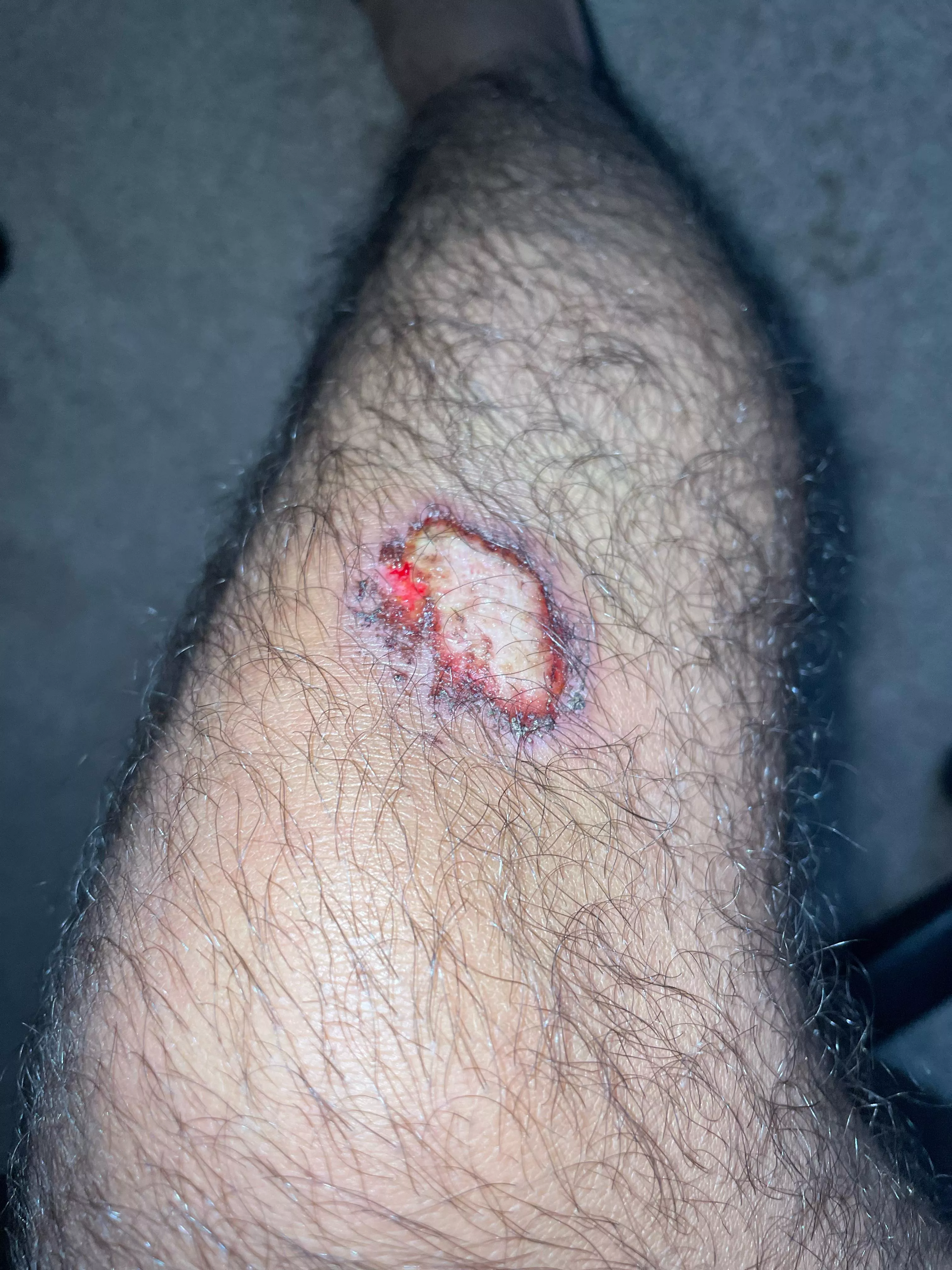Scab went from dry to this after shower (2 days old) posted by Stardust2u