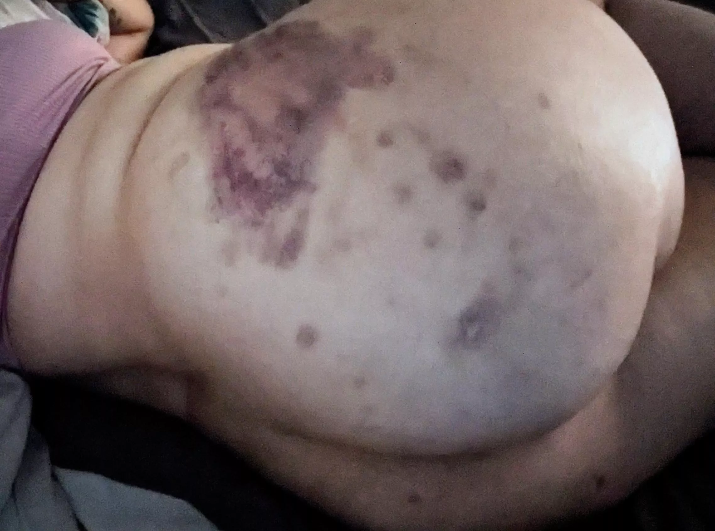 Another butt bruise for the collection 😄 posted by Pitiful_Fact_7664