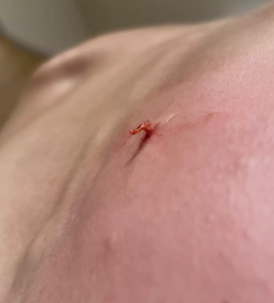 Vellus hair cyst popped posted by etkalafut