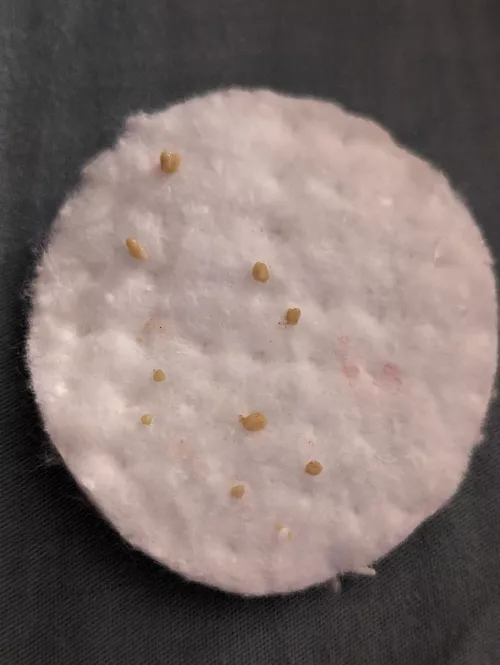 Left tonsil haul for the day. by xxlittlemissj