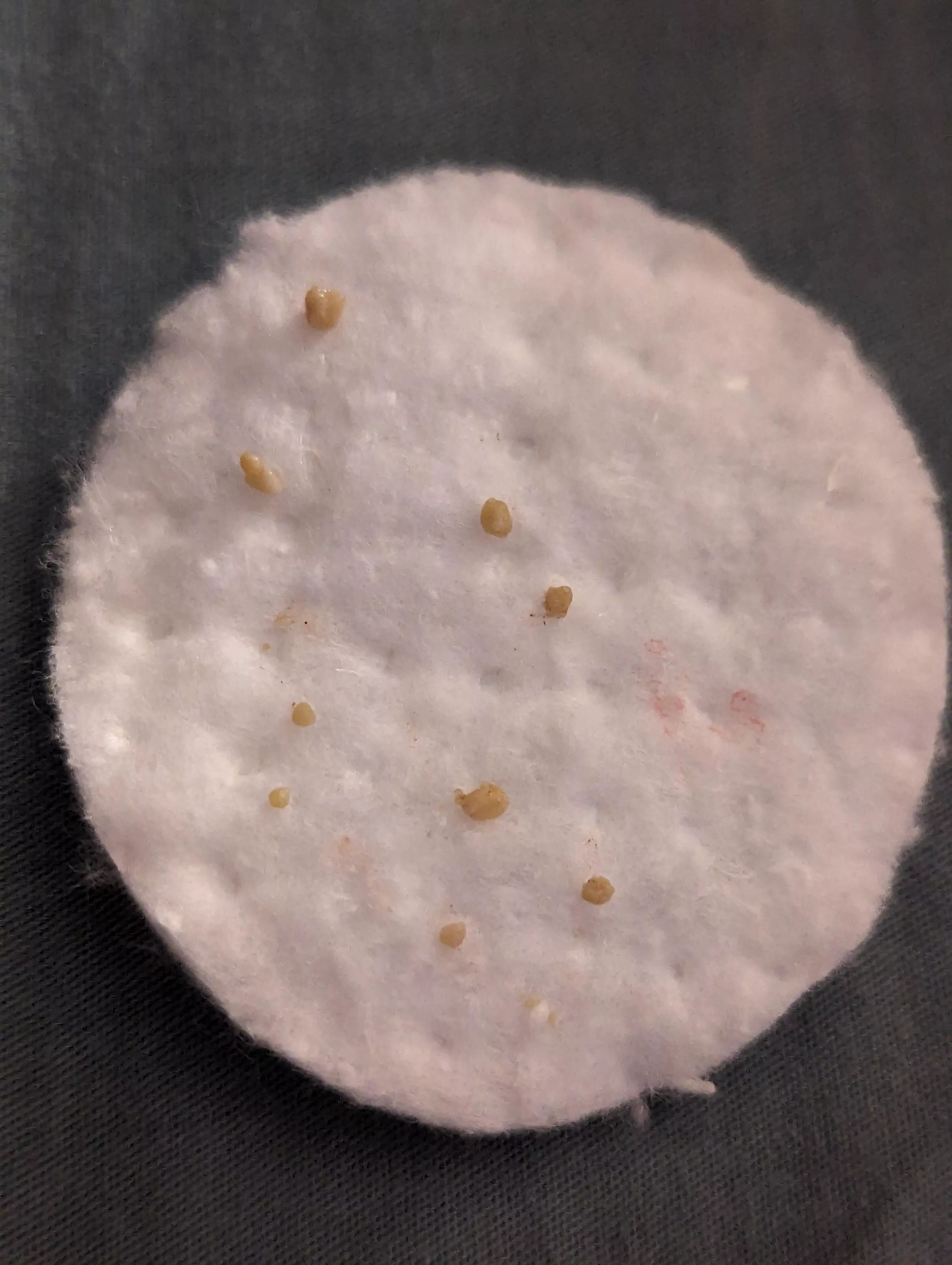 Left tonsil haul for the day. posted by xxlittlemissj