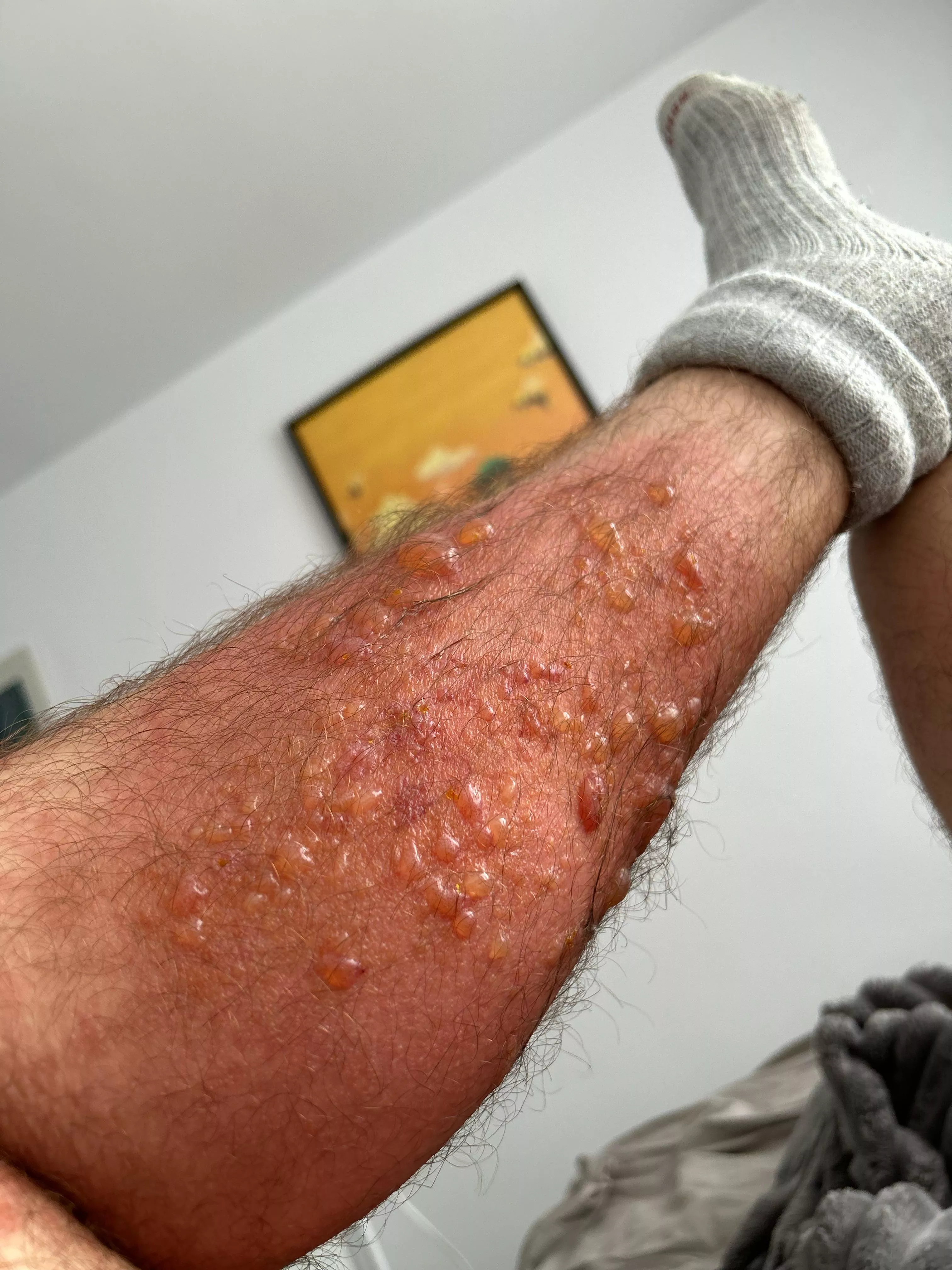 Sick and tired of poison ivy posted by Bigthom63