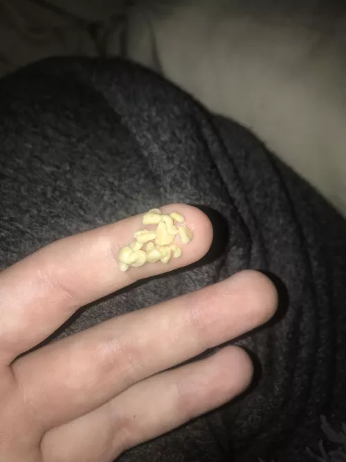 my absolute hoard of tonsil stones by AviaryAvian