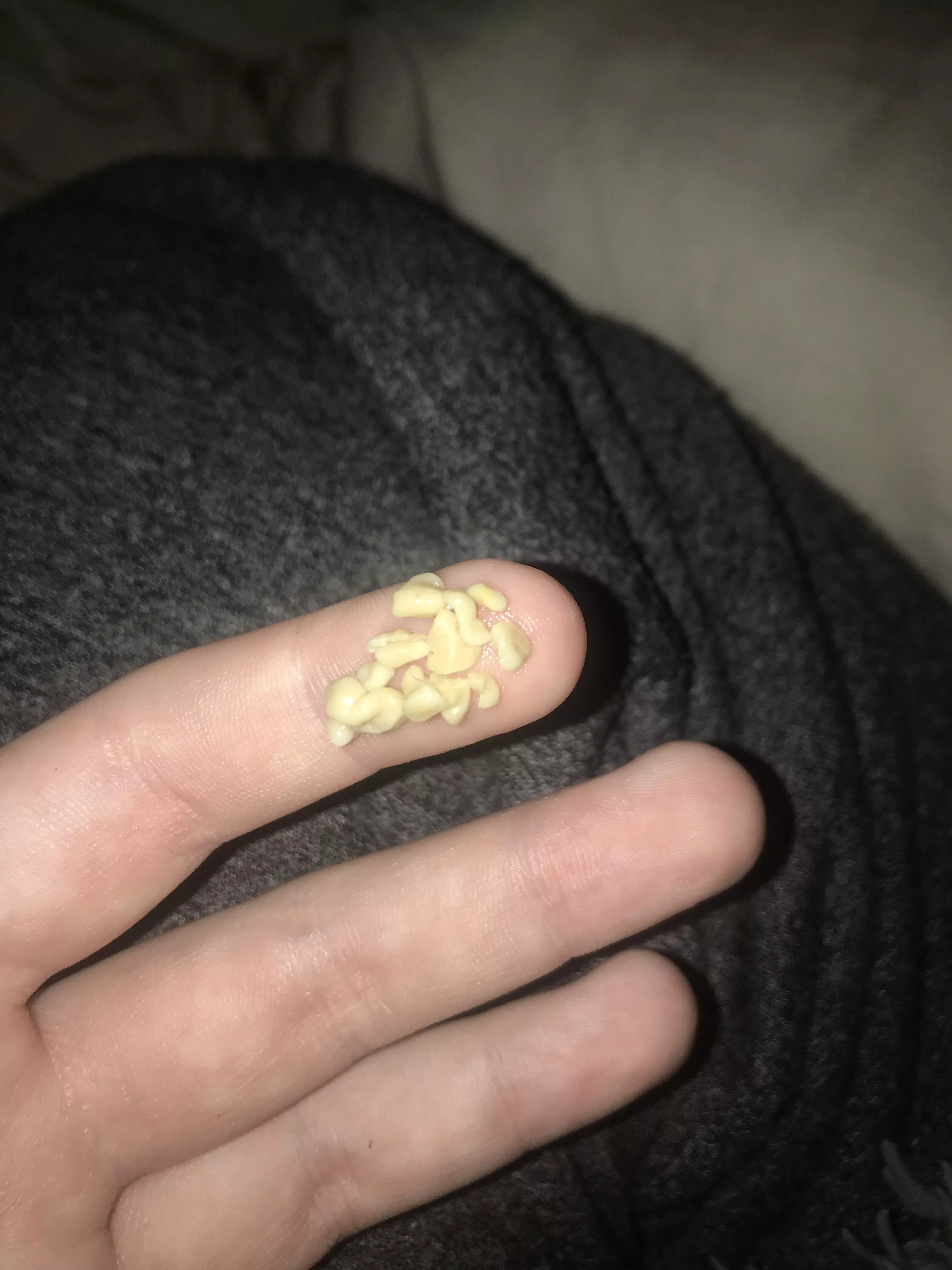 my absolute hoard of tonsil stones posted by AviaryAvian