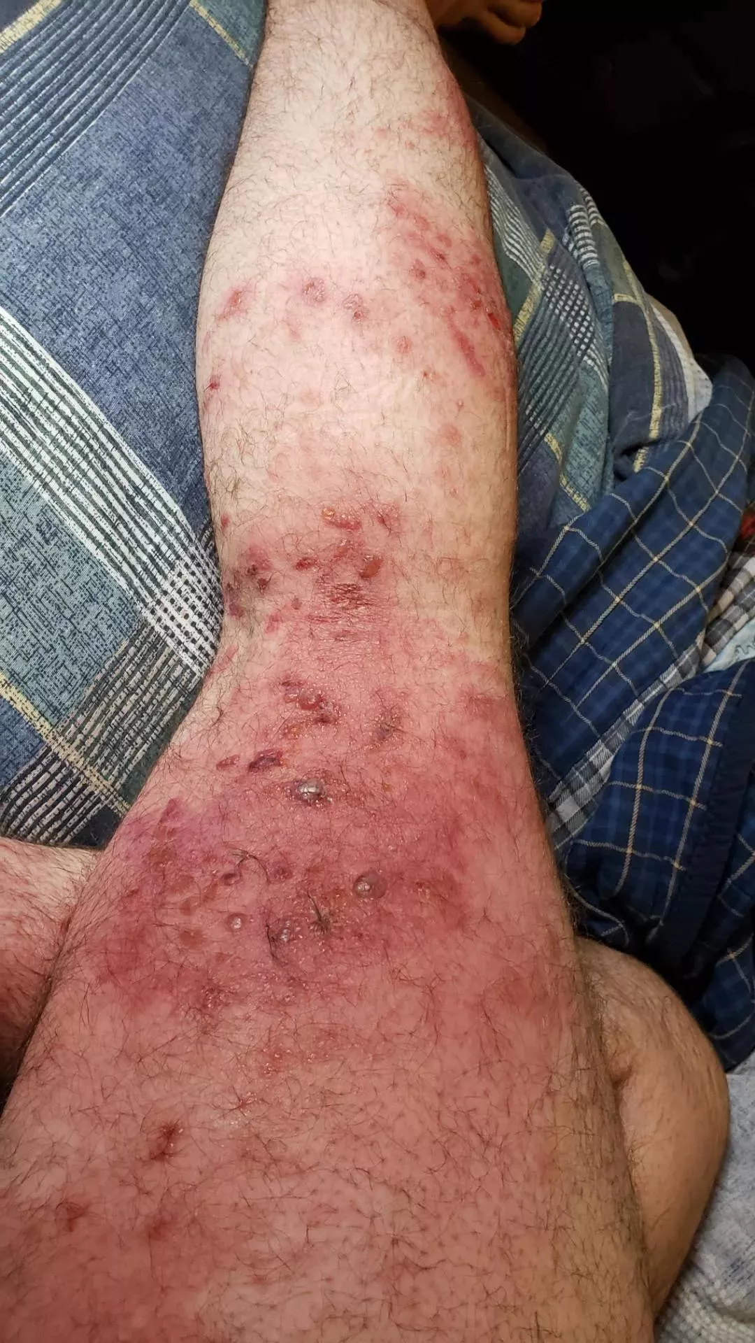 My leg looks like bubble wrap posted by jakethesnek64