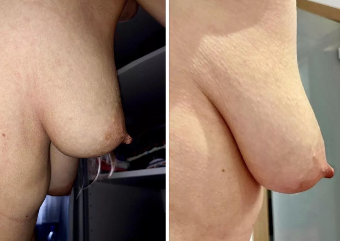 My transformation from firm breasts (my 20s) to sagging breasts (my 30s) (F35) posted by MacL0Vein