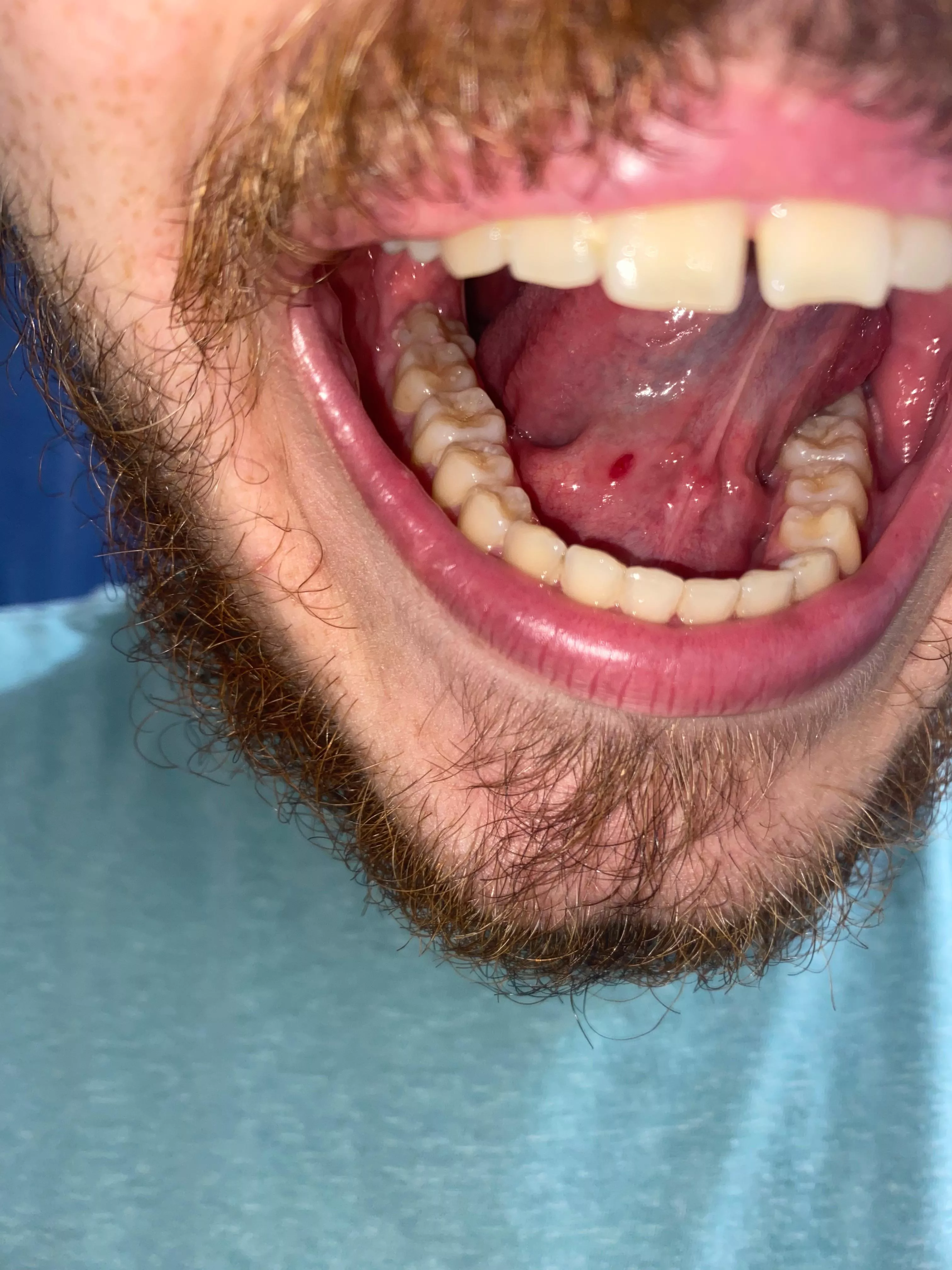 Help! I felt a really round lump under my tongue, I barely touched it and it popped. Wtf is this? posted by DownDeep99