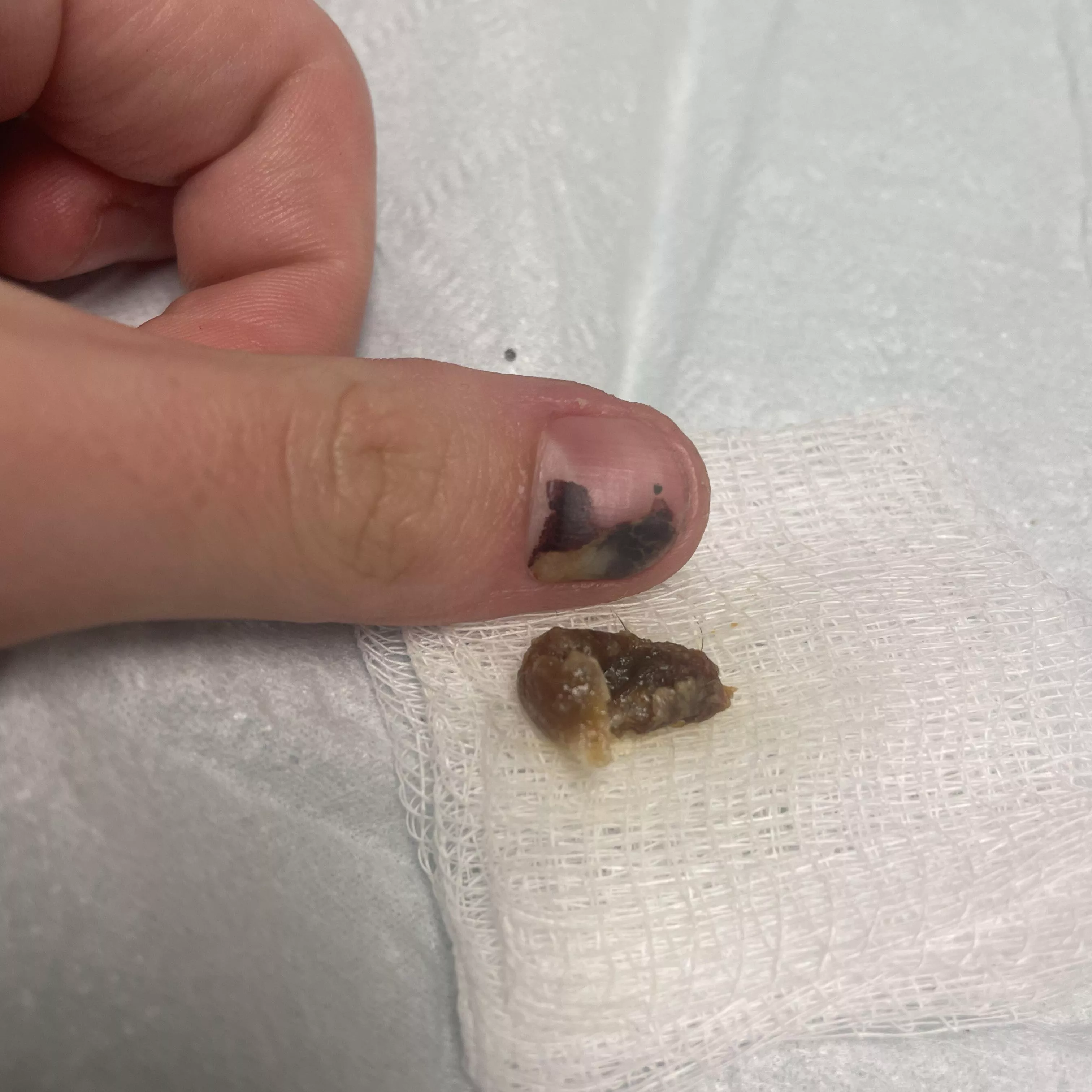 After 2 years of pain and dizziness, today I fully lost my hearing in one ear. Went to urgent care and they washed this bad boy out. posted by shadow_wolfxvx