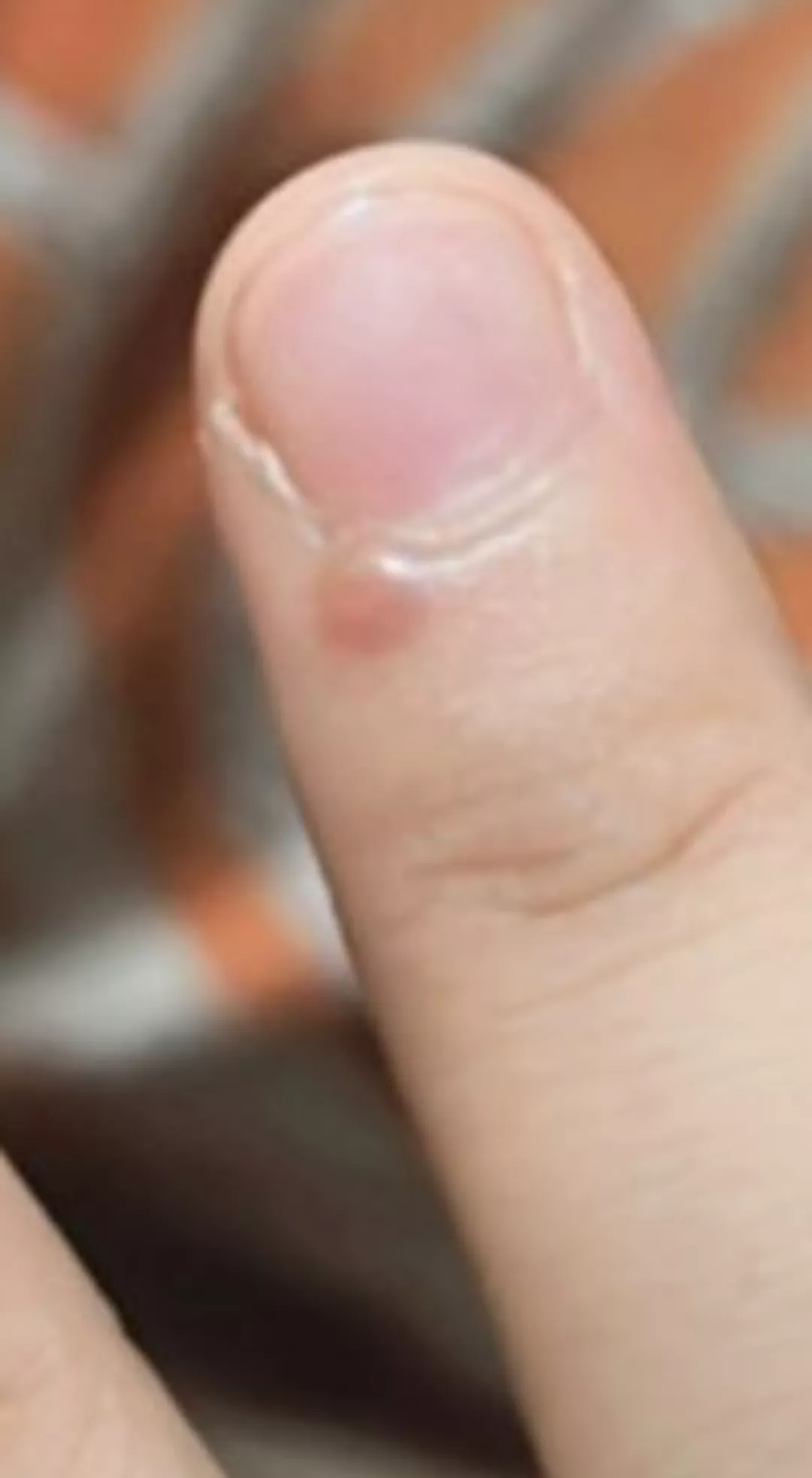 what's this small bump? it aches posted by Xulqarnaen