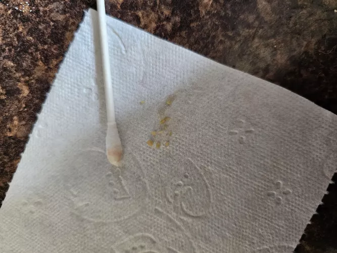 Tonsil stone haul after only 1 day by Purrrista