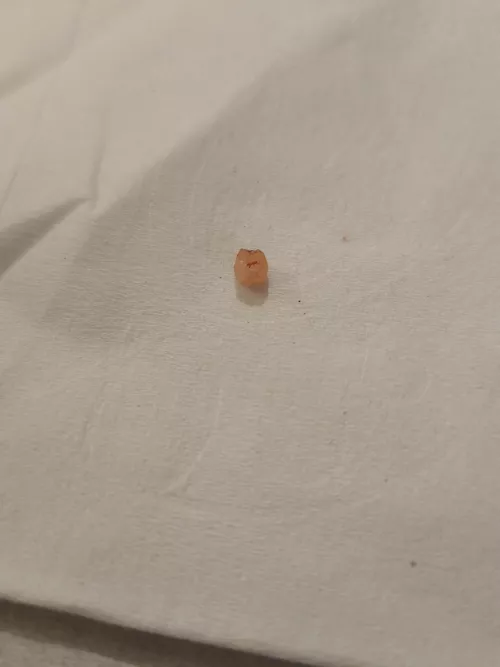 Farewell to one of the tiny cysts on my head by Noleebird