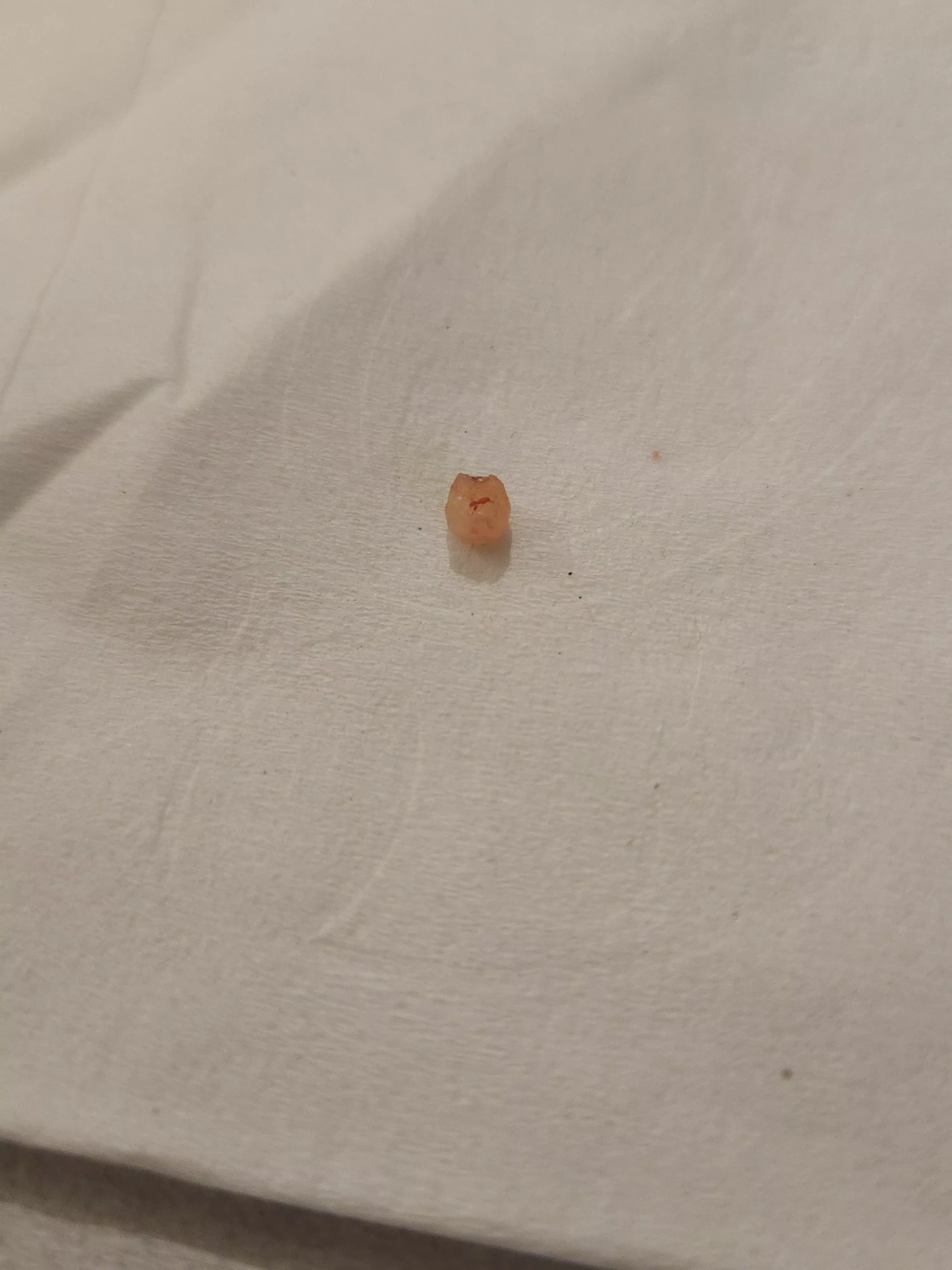 Farewell to one of the tiny cysts on my head posted by Noleebird