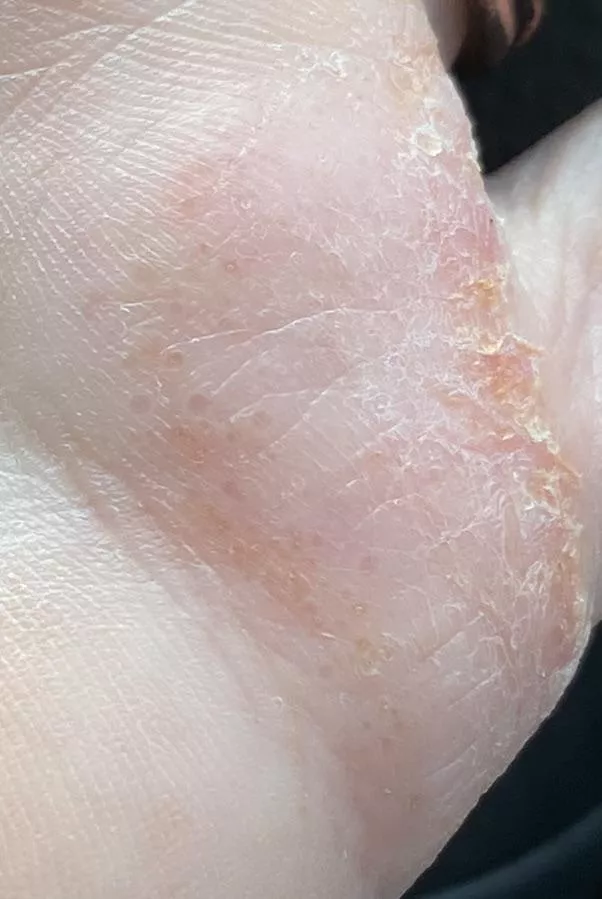 Forbidden pops on my hand posted by month4Hyde