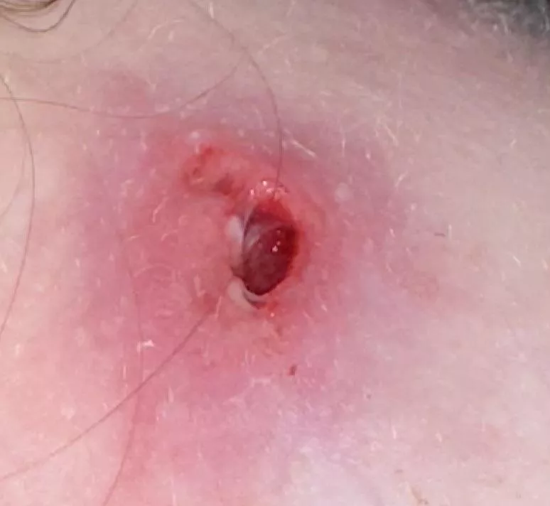 Hole from a sebaceous cyst I’ve been battling with for 2 weeks posted by alligatorskyy