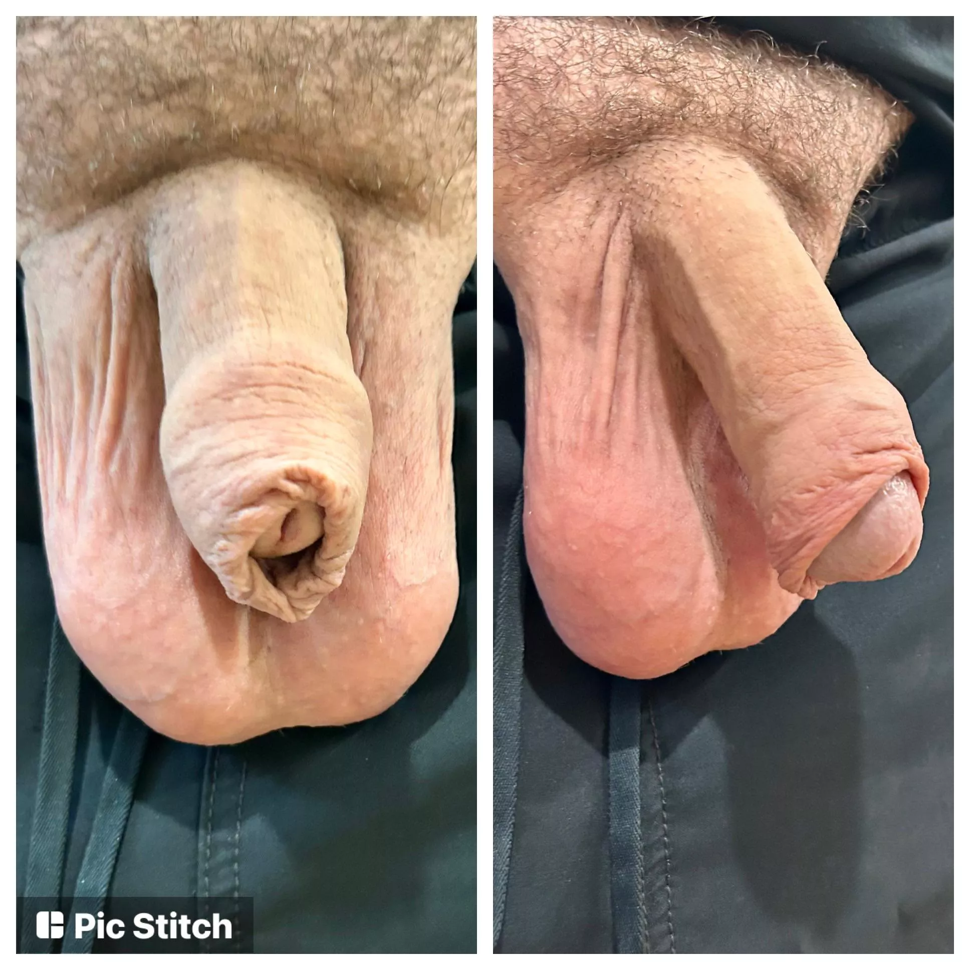 Restored foreskin. Took 7 years. Be glad you weren’t cut against your will! posted by CraziRooster